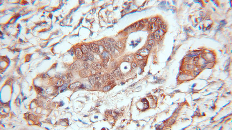 Immunohistochemical of paraffin-embedded human colon cancer using Catalog No:111351(HINT1 antibody) at dilution of 1:100 (under 10x lens)