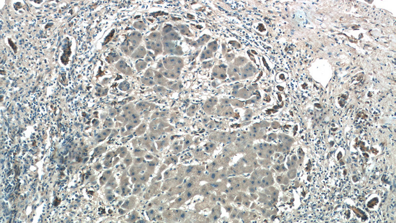 Immunohistochemistry of paraffin-embedded human hepatocirrhosis tissue slide using Catalog No:108830(CALM2 Antibody) at dilution of 1:50 (under 10x lens)