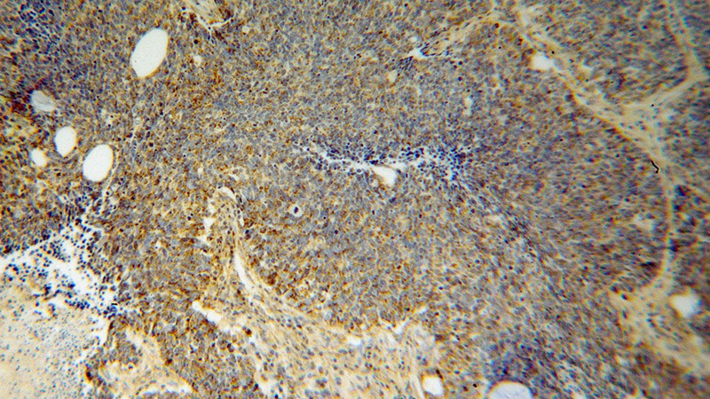 Immunohistochemical of paraffin-embedded human lung cancer using Catalog No:113331(OGDH antibody) at dilution of 1:100 (under 10x lens)