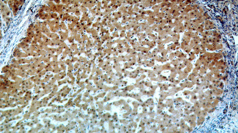 Immunohistochemical of paraffin-embedded human hepatocirrhosis using Catalog No:116401(TRNAU1AP,SECP43 antibody) at dilution of 1:50 (under 10x lens)