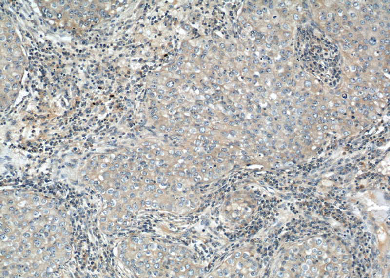 Immunohistochemical of paraffin-embedded human breast cancer using Catalog No:111686(IGFBP3 antibody) at dilution of 1:50 (under 10x lens)