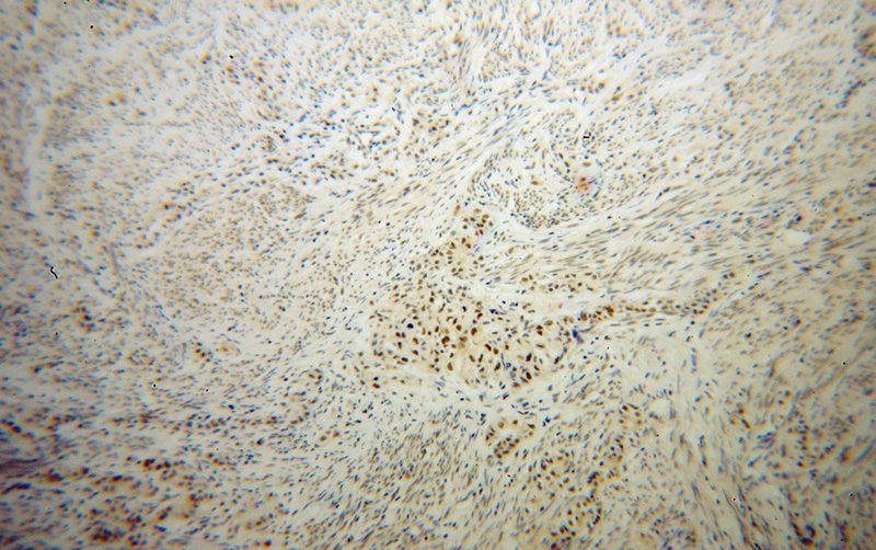 Immunohistochemical of paraffin-embedded human endometrial cancer using Catalog No:111833(IRF2BP1 antibody) at dilution of 1:50 (under 10x lens)