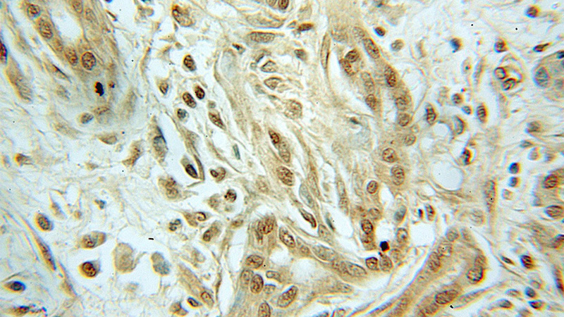 Immunohistochemical of paraffin-embedded human pancreas cancer using Catalog No:109275(CHRAC1 antibody) at dilution of 1:50 (under 10x lens)