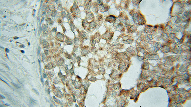 Immunohistochemical of paraffin-embedded human breast cancer using Catalog No:109656(CYB5R1 antibody) at dilution of 1:50 (under 10x lens)