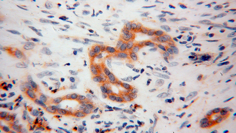 Immunohistochemical of paraffin-embedded human liver cancer using Catalog No:107968(ALDH3A2 antibody) at dilution of 1:100 (under 40x lens)