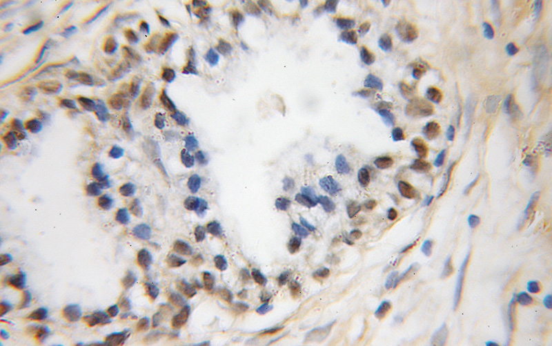Immunohistochemical of paraffin-embedded human prostate cancer using Catalog No:109901(DFFA,DFF45 antibody) at dilution of 1:100 (under 10x lens)
