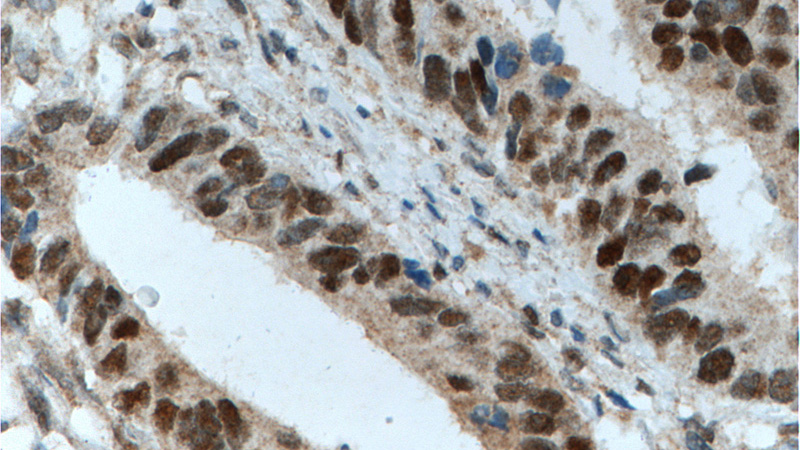 Immunohistochemistry of paraffin-embedded human colon cancer tissue slide using Catalog No:107430(MSH2 Antibody) at dilution of 1:800 (under 40x lens). heat mediated antigen retrieved with Tris-EDTA buffer(pH9).
