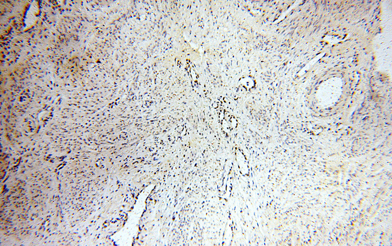 Immunohistochemical of paraffin-embedded human cervical cancer using Catalog No:113967(PLK1 antibody) at dilution of 1:50 (under 10x lens)