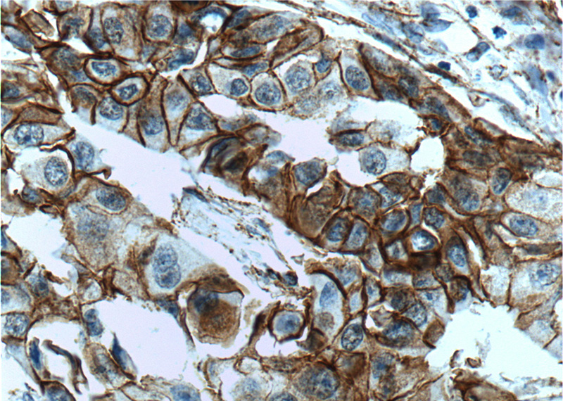 Immunohistochemistry of paraffin-embedded human breast ductal carcinoma tissue slide using Catalog No:107441 (CTNND1 Antibody) at dilution of 1:200 (under 40x lens). Heat mediated antigen retrieved with Tris-EDTA buffer(pH9).