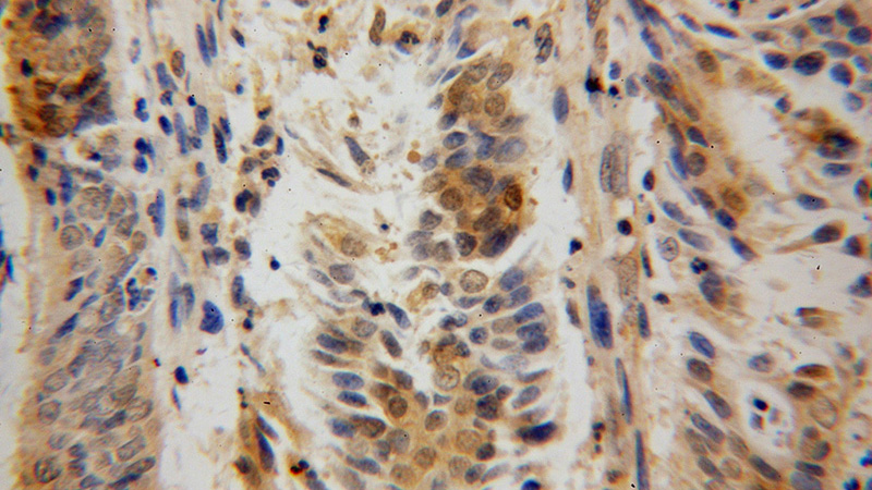 Immunohistochemical of paraffin-embedded human endometrial cancer using Catalog No:116514(UBA7 antibody) at dilution of 1:50 (under 40x lens)