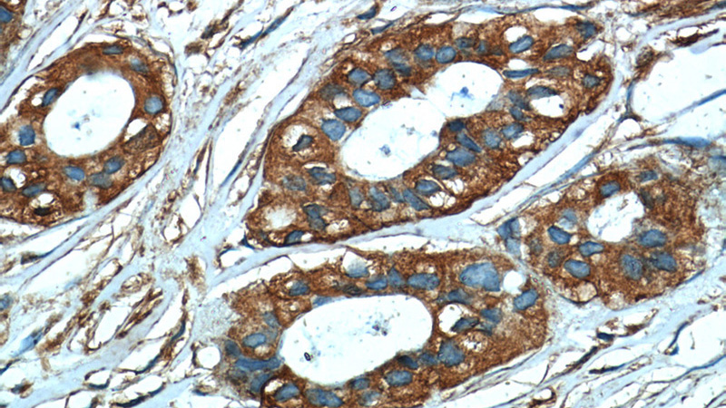 Immunohistochemistry of paraffin-embedded human breast cancer tissue slide using Catalog No:107292(GDI2 Antibody) at dilution of 1:50 (under 40x lens)