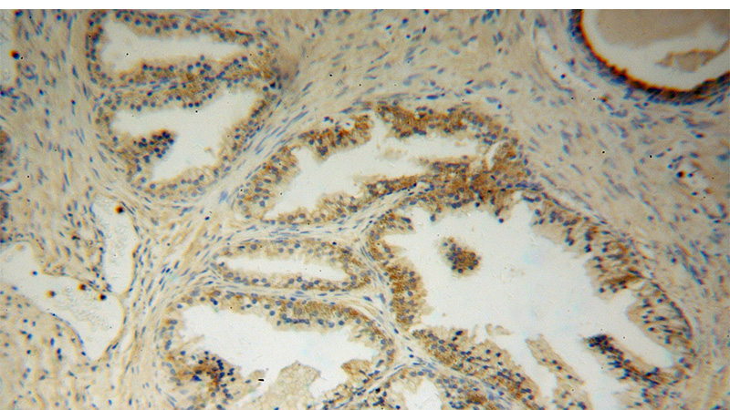 Immunohistochemical of paraffin-embedded human gliomas using Catalog No:114863(RTN3 antibody) at dilution of 1:50 (under 10x lens)
