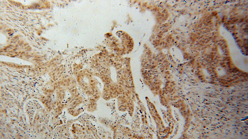 Immunohistochemical of paraffin-embedded human colon cancer using Catalog No:112473(MAP1S antibody) at dilution of 1:50 (under 10x lens)