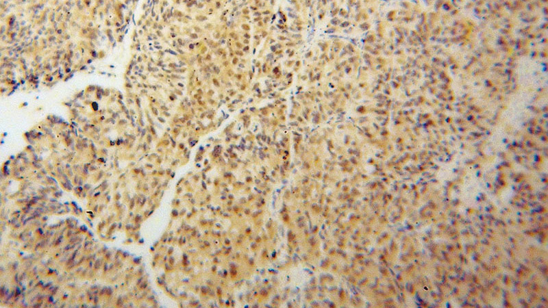 Immunohistochemical of paraffin-embedded human colon cancer using Catalog No:111832(IRF2 antibody) at dilution of 1:50 (under 10x lens)