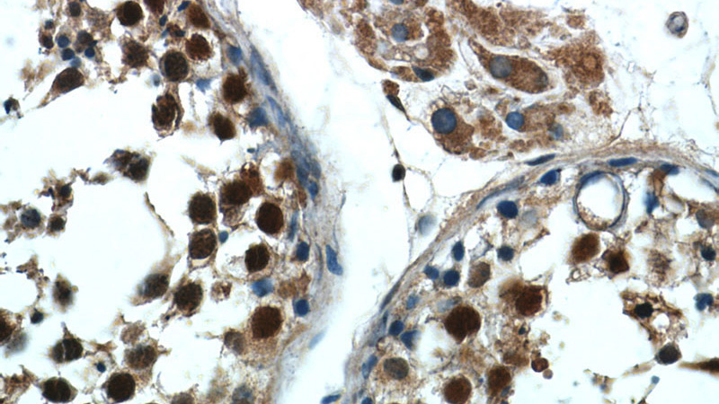 Immunohistochemistry of paraffin-embedded human testis tissue slide using Catalog No:112387(MAGEC2 Antibody) at dilution of 1:50 (under 40x lens)