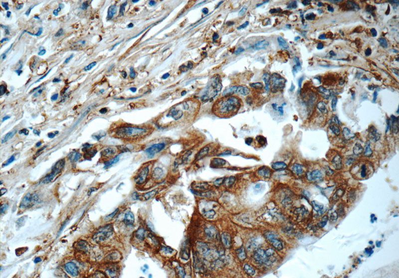 Immunohistochemistry of paraffin-embedded human pancreas cancer tissue slide using Catalog No:108932(CAP1 Antibody) at dilution of 1:50 (under 40x lens)