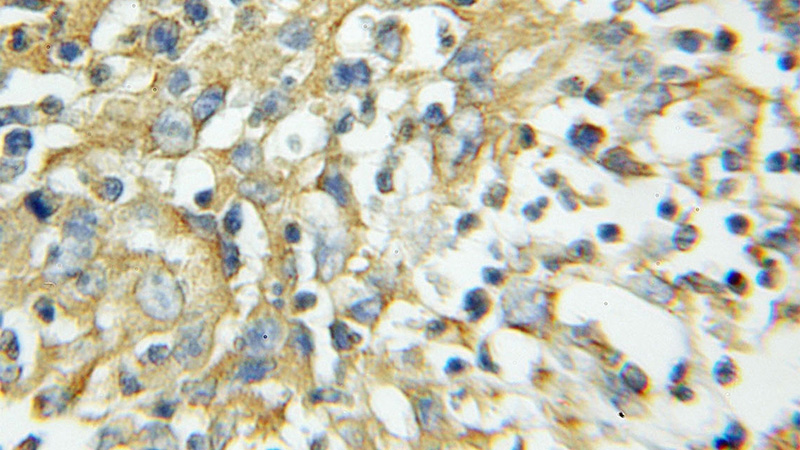 Immunohistochemical of paraffin-embedded human colon cancer using Catalog No:114200(PRKCSH antibody) at dilution of 1:100 (under 10x lens)