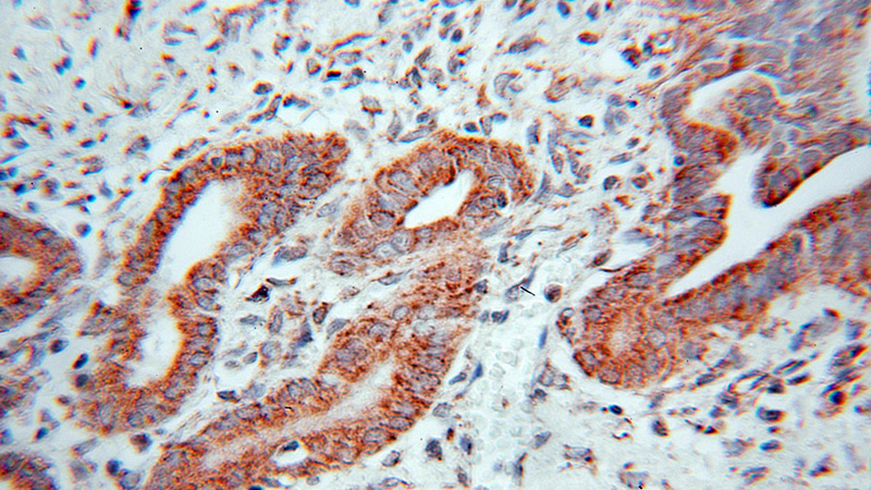Immunohistochemical of paraffin-embedded human pancreas cancer using Catalog No:114144(PPP1CC antibody) at dilution of 1:100 (under 10x lens)