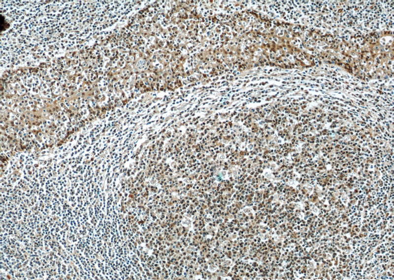 Immunohistochemistry of paraffin-embedded human tonsillitis slide using Catalog No:112549(MCL1 Antibody) at dilution of 1:50