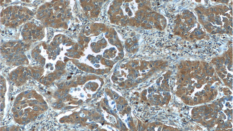 Immunohistochemistry of paraffin-embedded human lung cancer tissue slide using Catalog No:114921(RRAS2 Antibody) at dilution of 1:50 (under 10x lens)