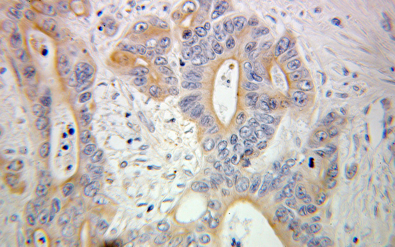 Immunohistochemical of paraffin-embedded human colon cancer using Catalog No:111703(HSPBP1 antibody) at dilution of 1:100 (under 25x lens)