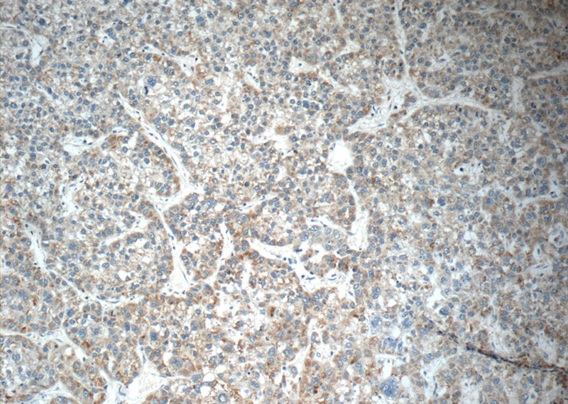Immunohistochemistry of paraffin-embedded human liver cancer tissue slide using Catalog No:110114(DUSP10 Antibody) at dilution of 1:50 (under 10x lens)