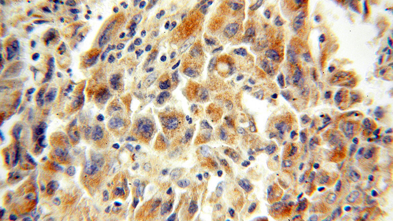 Immunohistochemical of paraffin-embedded human lung cancer using Catalog No:116993(XPNPEP3 antibody) at dilution of 1:100 (under 40x lens)