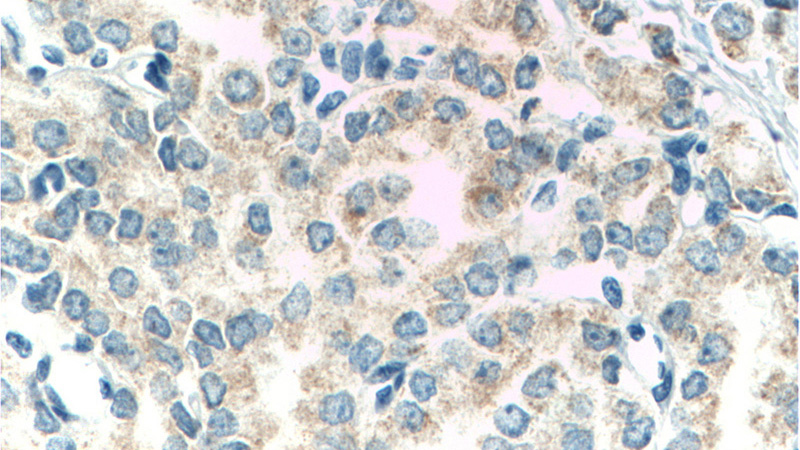 Immunohistochemistry of paraffin-embedded human prostate cancer tissue slide using Catalog No:114584(RDH11 Antibody) at dilution of 1:200 (under 40x lens). heat mediated antigen retrieved with Tris-EDTA buffer(pH9).