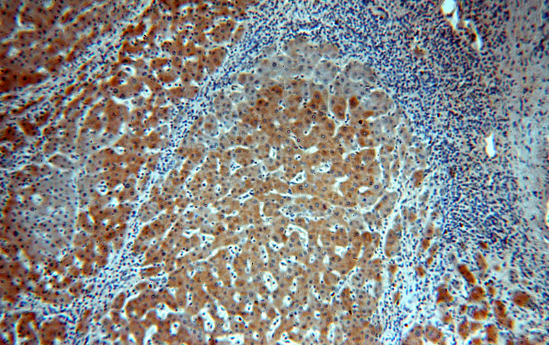 Immunohistochemical of paraffin-embedded human hepatocirrhosis using Catalog No:115064(SAR1A antibody) at dilution of 1:100 (under 10x lens)