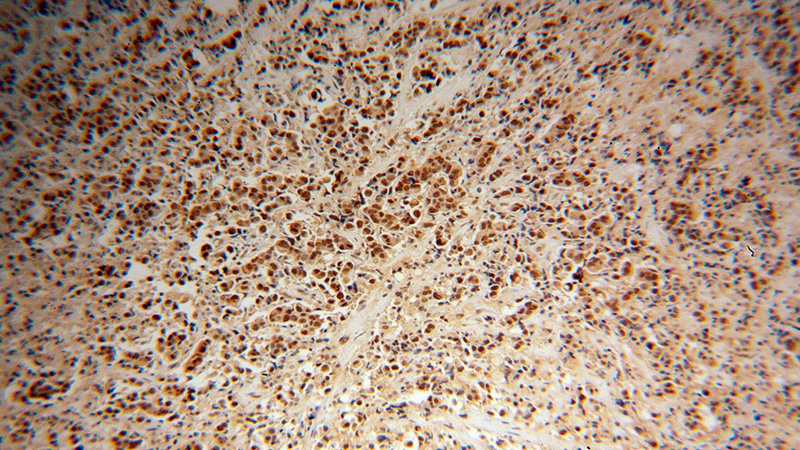 Immunohistochemical of paraffin-embedded human prostate cancer using Catalog No:116306(TRIM24 antibody) at dilution of 1:100 (under 10x lens)