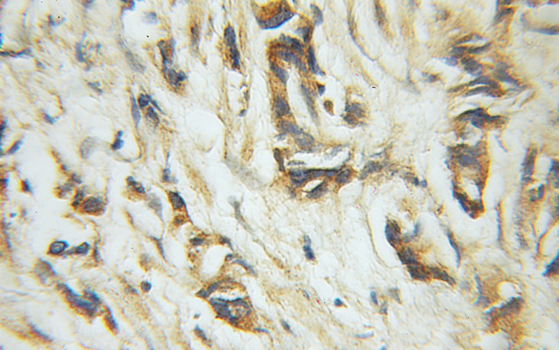 Immunohistochemical of paraffin-embedded human prostate cancer using Catalog No:109598(GPS1 antibody) at dilution of 1:50 (under 10x lens)