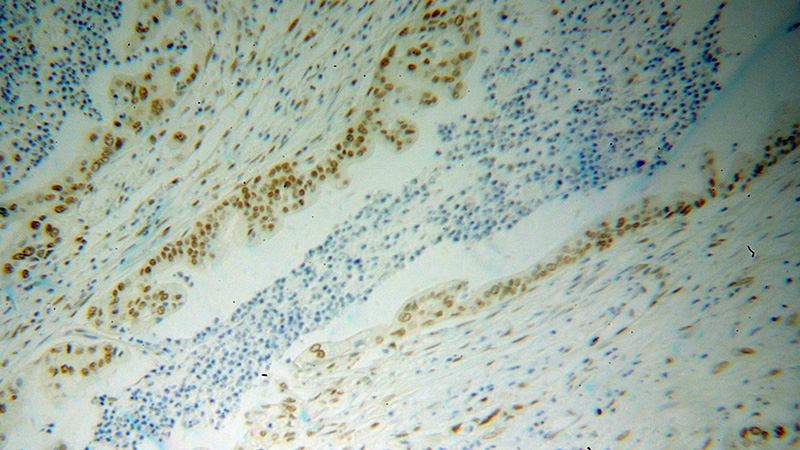 Immunohistochemical of paraffin-embedded human pancreas cancer using Catalog No:115148(SFRS17A antibody) at dilution of 1:100 (under 10x lens)
