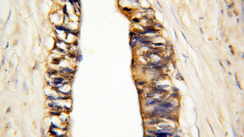 Immunohistochemical of paraffin-embedded human breast cancer using Catalog No:112706(MMP3 antibody) at dilution of 1:100 (under 40x lens)