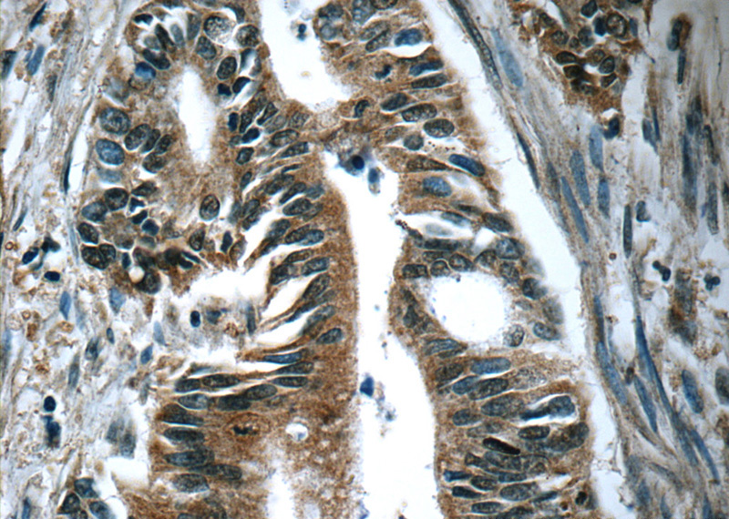 Immunohistochemistry of paraffin-embedded human pancreas cancer tissue slide using Catalog No:107583(AMY2A Antibody) at dilution of 1:50(under 40x lens)