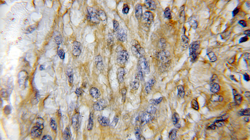 Immunohistochemical of paraffin-embedded human gliomas using Catalog No:114423(RAB24 antibody) at dilution of 1:50 (under 10x lens)
