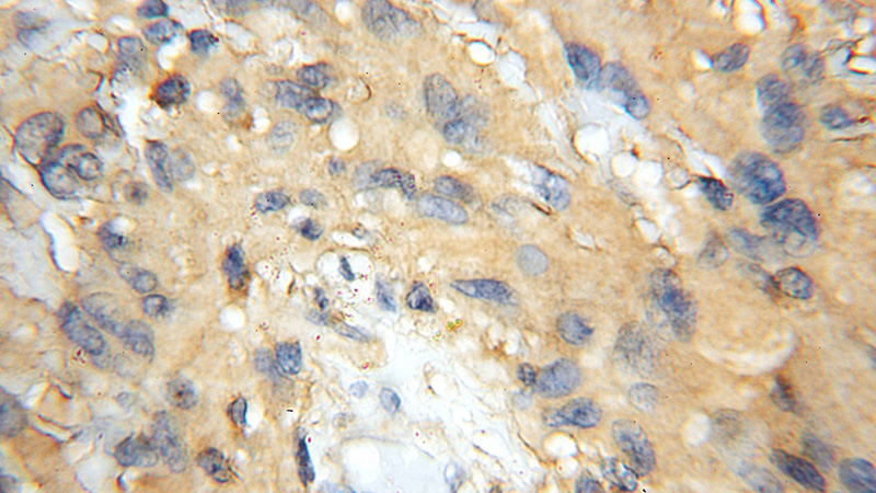 Immunohistochemical of paraffin-embedded human gliomas using Catalog No:114184(PREP antibody) at dilution of 1:50 (under 10x lens)