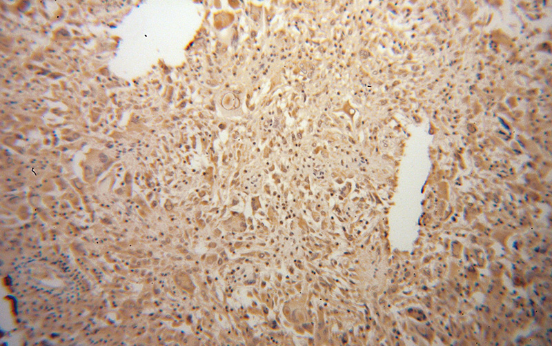 Immunohistochemical of paraffin-embedded human gliomas using Catalog No:114136(PPM1K antibody) at dilution of 1:50 (under 10x lens)
