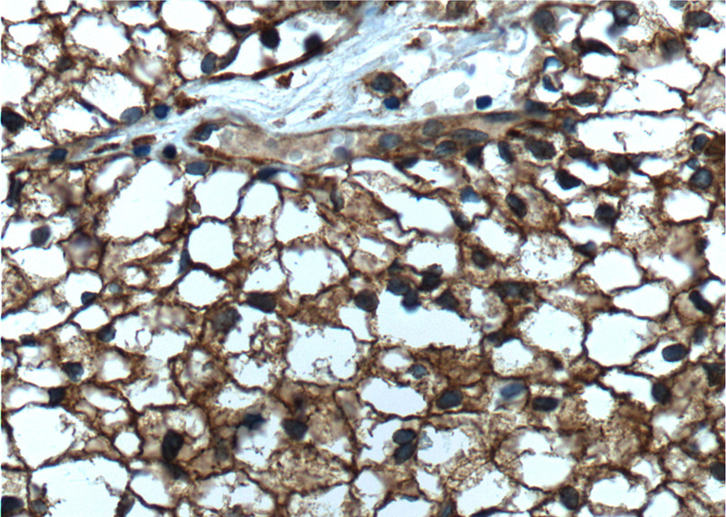 Immunohistochemistry of paraffin-embedded human renal cell carcinoma tissue slide using Catalog No:107524(SEPT2 Antibody) at dilution of 1:800 (under 40x lens). heat mediated antigen retrieved with Tris-EDTA buffer(pH9).