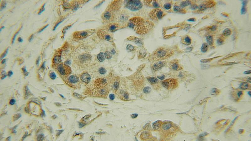 Immunohistochemical of paraffin-embedded human pancreas cancer using Catalog No:113550(P4HA1 antibody) at dilution of 1:100 (under 10x lens)