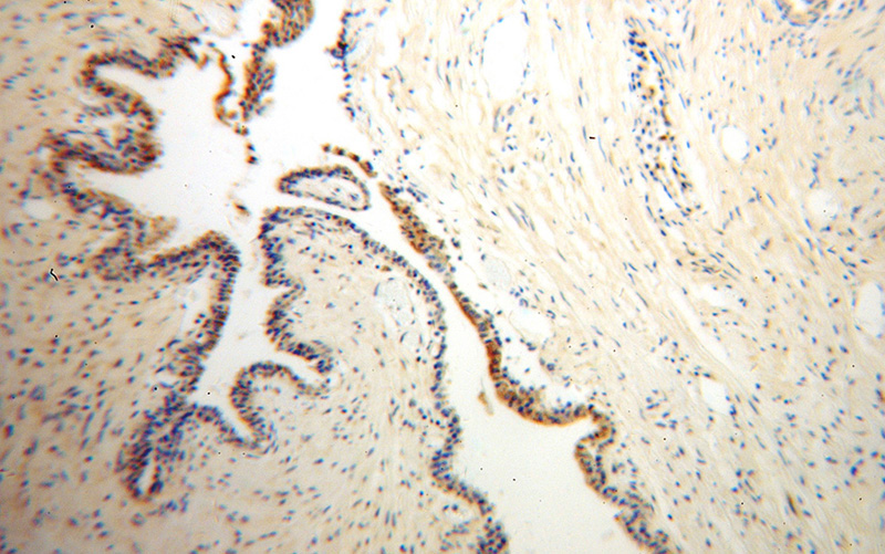 Immunohistochemical of paraffin-embedded human gliomas using Catalog No:108199(ARL2BP antibody) at dilution of 1:50 (under 10x lens)