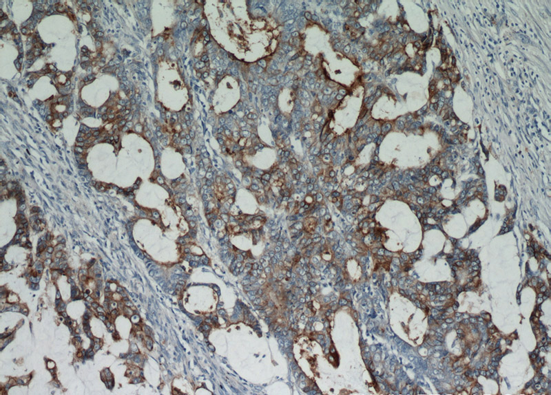 Immunohistochemical of paraffin-embedded human colon cancer using Catalog No:109242(CEA antibody) at dilution of 1:50 (under 10x lens)
