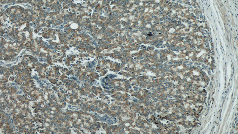 Immunohistochemical of paraffin-embedded human prostate cancer using Catalog No:107172(COXIV antibody) at dilution of 1:100 (under 10x lens)