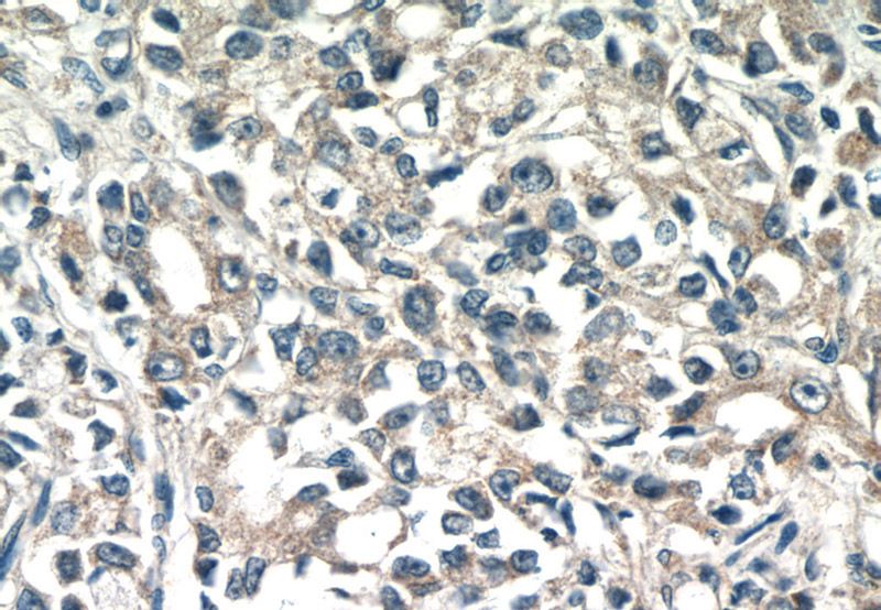 Immunohistochemistry of paraffin-embedded human prostate cancer tissue slide using Catalog No:116196(TMEM71 Antibody) at dilution of 1:50 (under 40x lens)