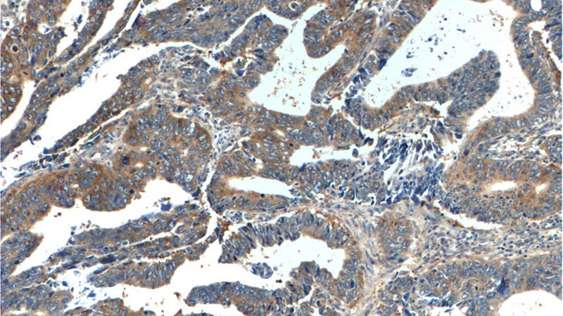 Immunohistochemistry of paraffin-embedded human colon cancer tissue slide using Catalog No:116220(TPT1 Antibody) at dilution of 1:200 (under 10x lens).
