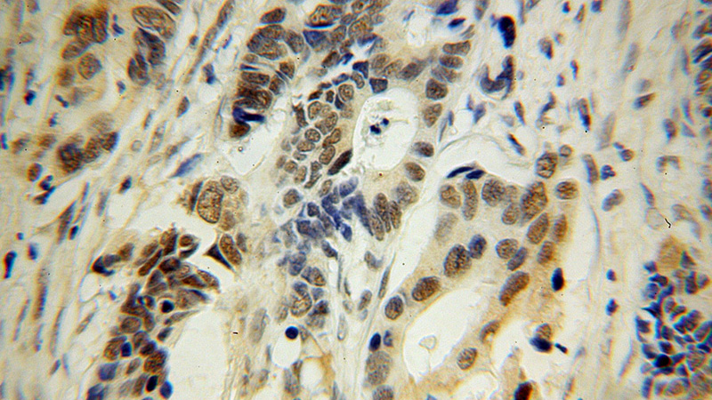 Immunohistochemical of paraffin-embedded human colon cancer using Catalog No:116010(TFEC antibody) at dilution of 1:100 (under 40x lens)