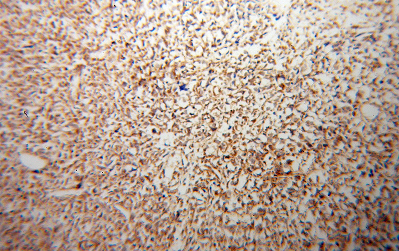 Immunohistochemical of paraffin-embedded human osteosarcoma using Catalog No:108357(ATP5J antibody) at dilution of 1:100 (under 10x lens)