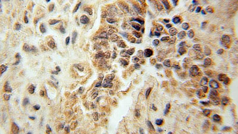 Immunohistochemical of paraffin-embedded human ovary tumor using Catalog No:112578(Mecr antibody) at dilution of 1:100 (under 10x lens)