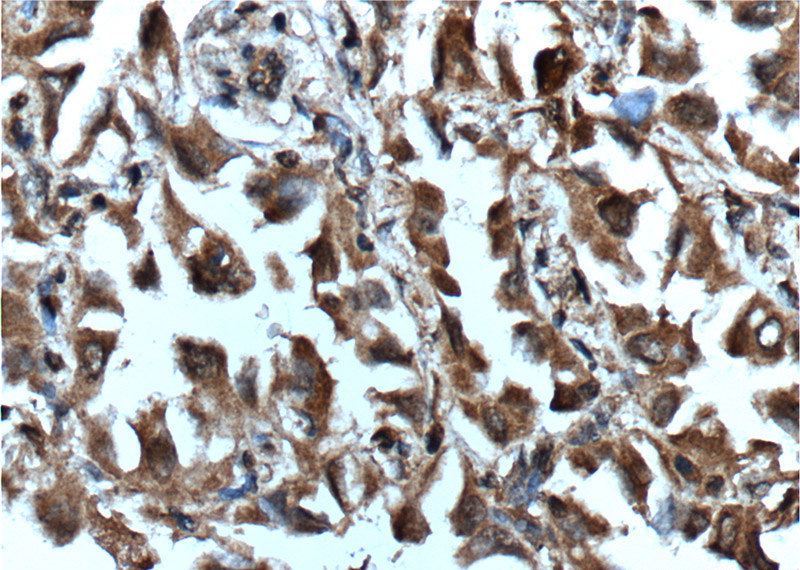 Immunohistochemistry of paraffin-embedded human lung cancer tissue slide using Catalog No:107348(INHBA-Specific Antibody) at dilution of 1:150 (under 40x lens). Heat mediated antigen retrieved with Tris-EDTA buffer(pH9).