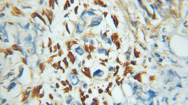 Immunohistochemical of paraffin-embedded human prostate cancer using Catalog No:117152(ZNF266 antibody) at dilution of 1:100 (under 10x lens)