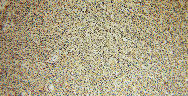 Immunohistochemical of paraffin-embedded human lymphoma using Catalog No:110051(DOK3 antibody) at dilution of 1:50 (under 10x lens)